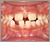 下顎前突症【受け口・混合歯列期】の症例4