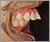 上顎前突症【出っ歯・永久歯列期】の症例8