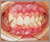 上顎前突症【出っ歯・永久歯列期】の症例13