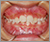 先天性欠如歯【永久歯の先天性欠如】の症例4