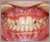 矮小歯の症例3