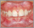上顎前突症【出っ歯・混合歯列期】の症例16