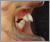 上顎前突症【出っ歯・混合歯列期】の症例21