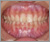 臼歯部交叉咬合【顔面非対称・永久歯列期】の症例6