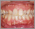 下顎前突症【受け口・永久歯列期】の症例10