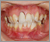 上顎前突症【出っ歯・永久歯列期】の症例35