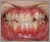 外傷歯の症例3