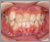 外傷歯の症例4