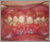 埋伏歯【永久歯列期】の症例2