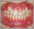 外傷歯の症例5