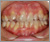 癒合歯の症例2