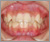 癒合歯の症例3