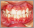 上下顎前突症【出っ歯】の症例1