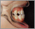 下顎前突症【受け口・永久歯列期】の症例1