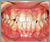 下顎前突症【受け口・永久歯列期】の症例2