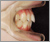 上下顎前突症【出っ歯】の症例2