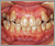 臼歯部交叉咬合【顔面非対称・永久歯列期】の症例1