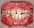 下顎前突症【受け口・混合歯列期】の症例1