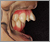 上顎前突症【出っ歯・永久歯列期】の症例1