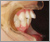 上下顎前突症【出っ歯】の症例3