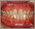 臼歯部交叉咬合【顔面非対称・永久歯列期】の症例2