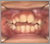 開咬症【混合歯列期】の症例1