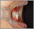 下顎前突症【受け口・永久歯列期】の症例3