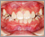 埋伏歯【混合歯列期】の症例1