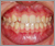 矮小歯の症例1
