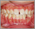 埋伏歯【永久歯列期】の症例4