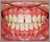 上下顎前突症【出っ歯】の症例4