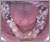 埋伏歯【永久歯列期】の症例1
