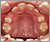 埋伏歯【混合歯列期】の症例2