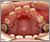 埋伏歯【混合歯列期】の症例3
