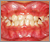 下顎前突症【受け口・混合歯列期】の症例2