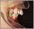 上顎前突症【出っ歯・永久歯列期】の症例6