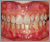 矮小歯の症例2