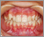 臼歯部交叉咬合【顔面非対称・永久歯列期】の症例3
