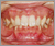 先天性欠如歯【永久歯の先天性欠如】の症例1