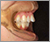 舌側矯正【舌側からの見えない治療】の症例3