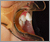 上顎前突症【出っ歯・混合歯列期】の症例1