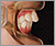 上顎前突症【出っ歯・混合歯列期】の症例3