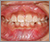 上顎前突症【出っ歯・混合歯列期】の症例4