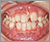 埋伏歯【混合歯列期】の症例4