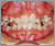 臼歯部交叉咬合【顔面非対称・混合歯列期】の症例2