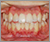 上下顎前突症【出っ歯】の症例5