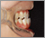 下顎前突症【受け口・永久歯列期】の症例4