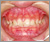 上顎前突症【出っ歯・混合歯列期】の症例5
