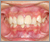 外傷歯の症例6