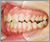 先天性欠如歯【永久歯の先天性欠如】の症例3
